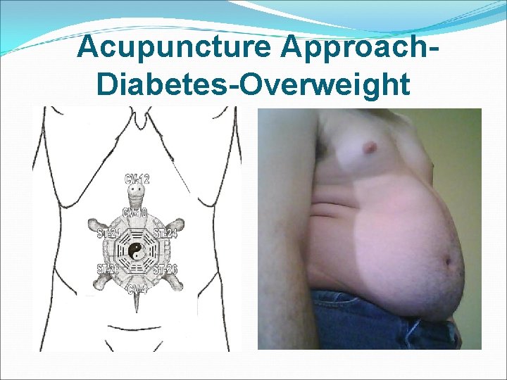  Acupuncture Approach- Diabetes-Overweight 