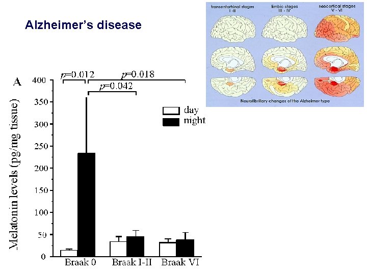 Alzheimer’s disease 