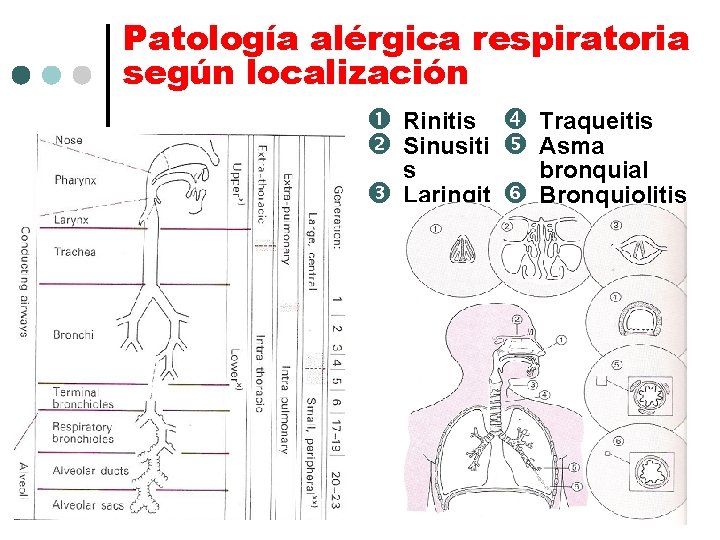 Patología alérgica respiratoria según localización Rinitis Traqueitis Sinusiti Asma s Laringit is bronquial Bronquiolitis