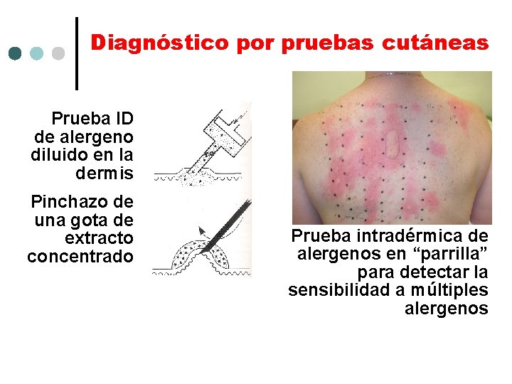 Diagnóstico por pruebas cutáneas Prueba ID de alergeno diluido en la dermis Pinchazo de