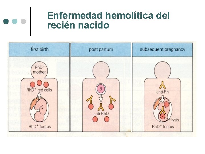 Enfermedad hemolítica del recién nacido 