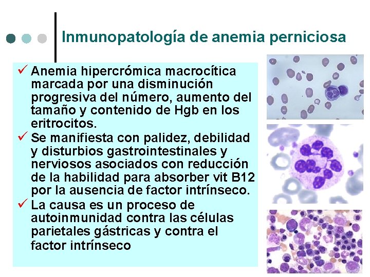 Inmunopatología de anemia perniciosa ü Anemia hipercrómica macrocítica marcada por una disminución progresiva del