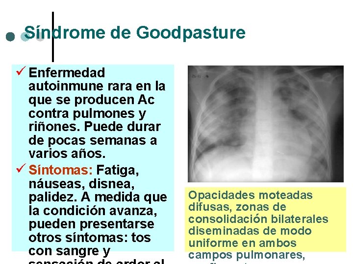 Síndrome de Goodpasture ü Enfermedad autoinmune rara en la que se producen Ac contra