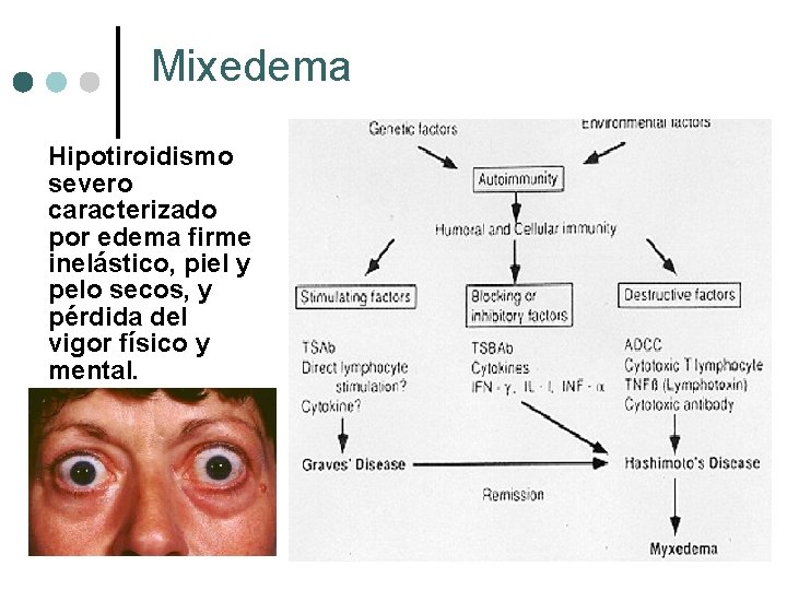 Mixedema Hipotiroidismo severo caracterizado por edema firme inelástico, piel y pelo secos, y pérdida