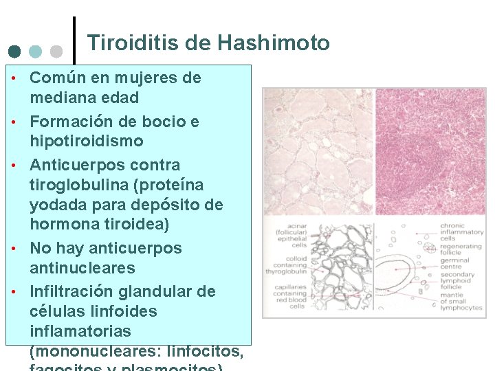 Tiroiditis de Hashimoto • Común en mujeres de • • mediana edad Formación de