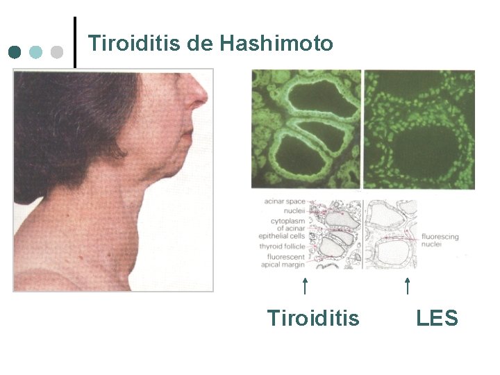 Tiroiditis de Hashimoto Tiroiditis LES 