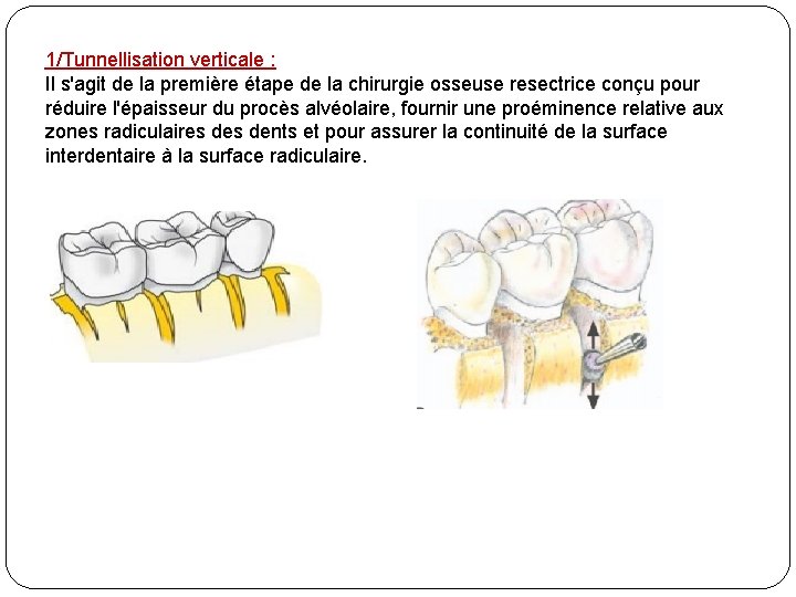 1/Tunnellisation verticale : Il s'agit de la première étape de la chirurgie osseuse resectrice