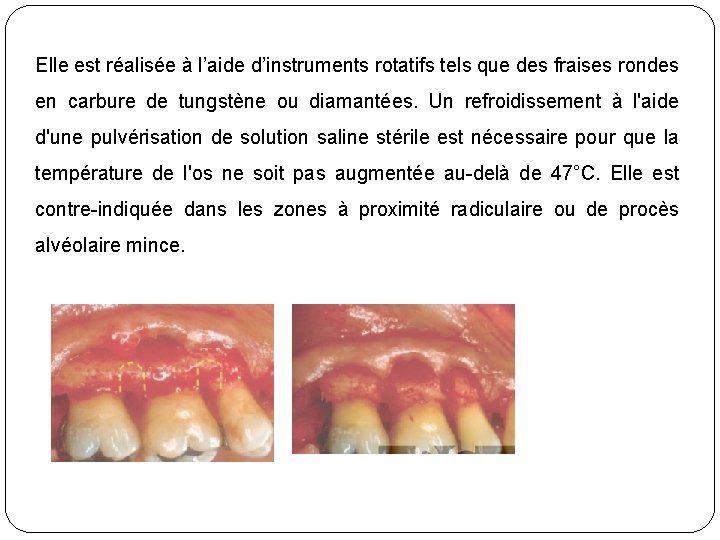 Elle est réalisée à l’aide d’instruments rotatifs tels que des fraises rondes en carbure