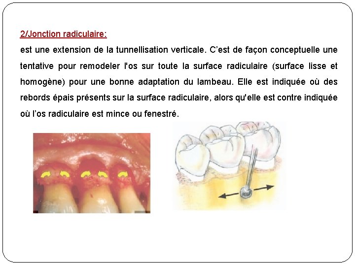 2/Jonction radiculaire: est une extension de la tunnellisation verticale. C’est de façon conceptuelle une