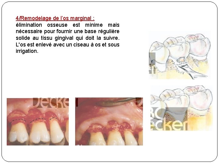 4/Remodelage de l’os marginal : élimination osseuse est minime mais nécessaire pour fournir une