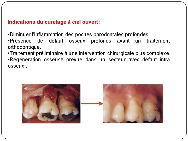 Indications du curetage à ciel ouvert: • Diminuer l’inflammation des poches parodontales profondes. •