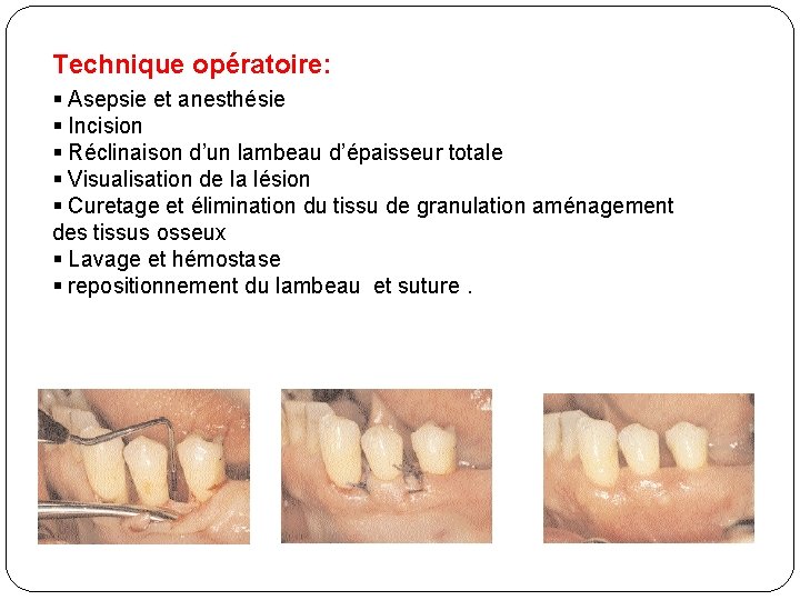 Technique opératoire: § Asepsie et anesthésie § Incision § Réclinaison d’un lambeau d’épaisseur totale