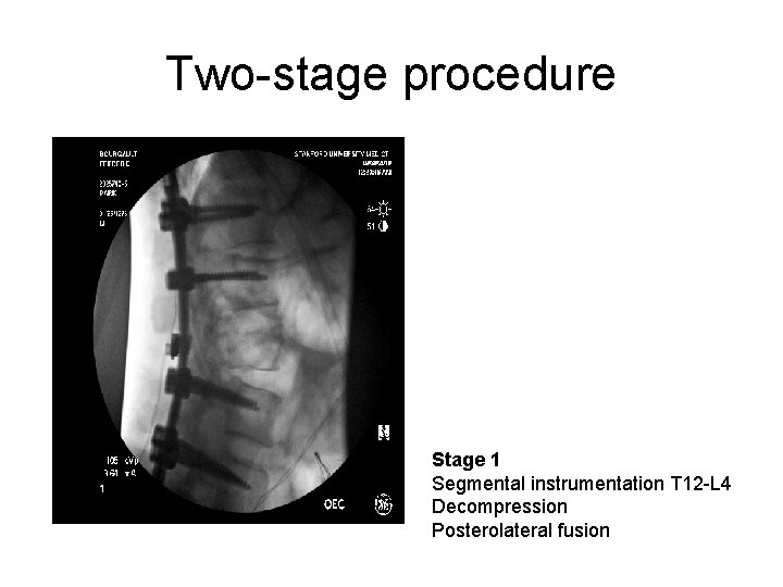 Two-stage procedure Stage 1 Segmental instrumentation T 12 -L 4 Decompression Posterolateral fusion 