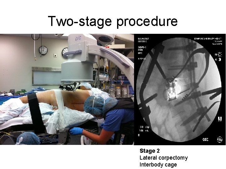 Two-stage procedure Stage 2 Lateral corpectomy Interbody cage 