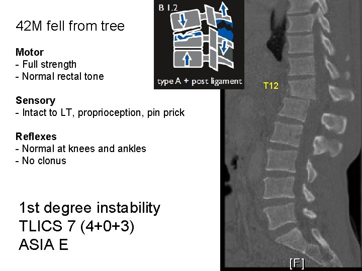 42 M fell from tree Motor - Full strength - Normal rectal tone Sensory