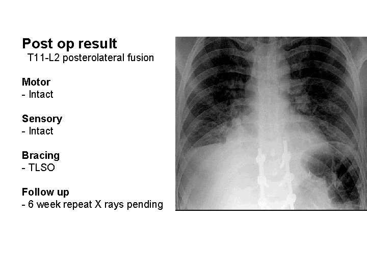 Post op result T 11 -L 2 posterolateral fusion Motor - Intact Sensory -