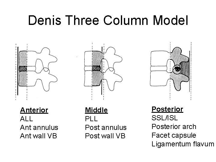 Denis Three Column Model Anterior ALL Ant annulus Ant wall VB Middle PLL Post