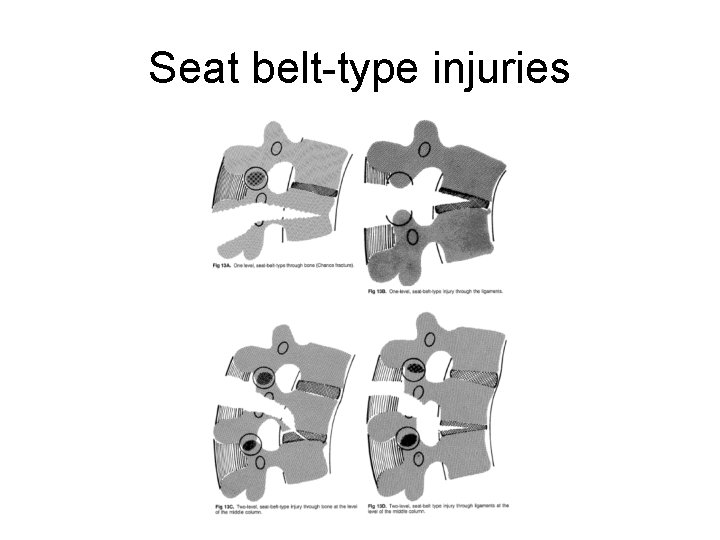 Seat belt-type injuries 