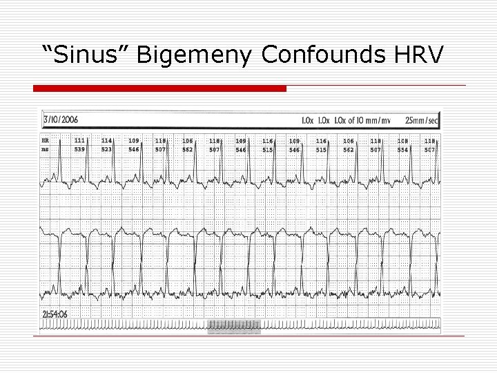 “Sinus” Bigemeny Confounds HRV 