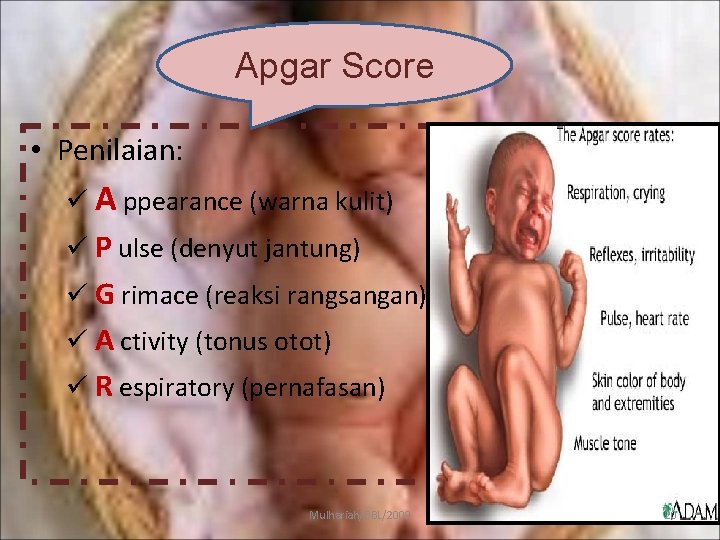 Apgar Score • Penilaian: ü A ppearance (warna kulit) ü P ulse (denyut jantung)