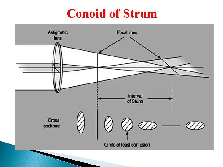 Conoid of Strum 