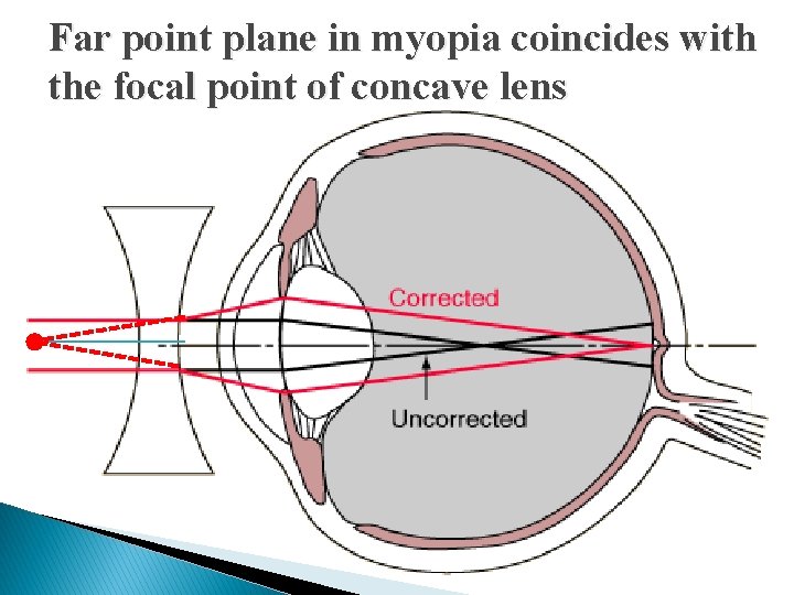 Far point plane in myopia coincides with the focal point of concave lens 