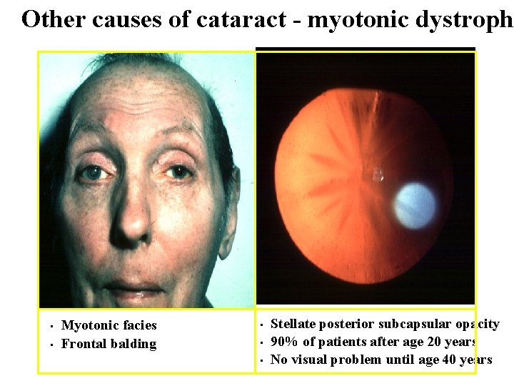 Other causes of cataract - myotonic dystroph • • Myotonic facies Frontal balding •
