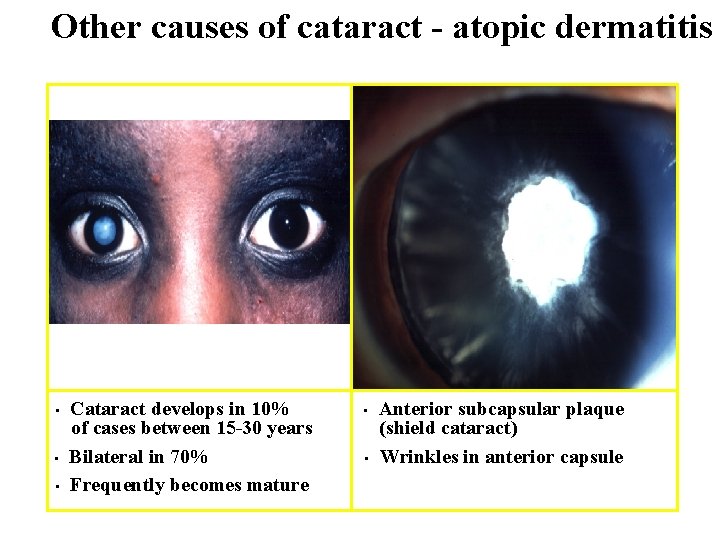 Other causes of cataract - atopic dermatitis • • • Cataract develops in 10%