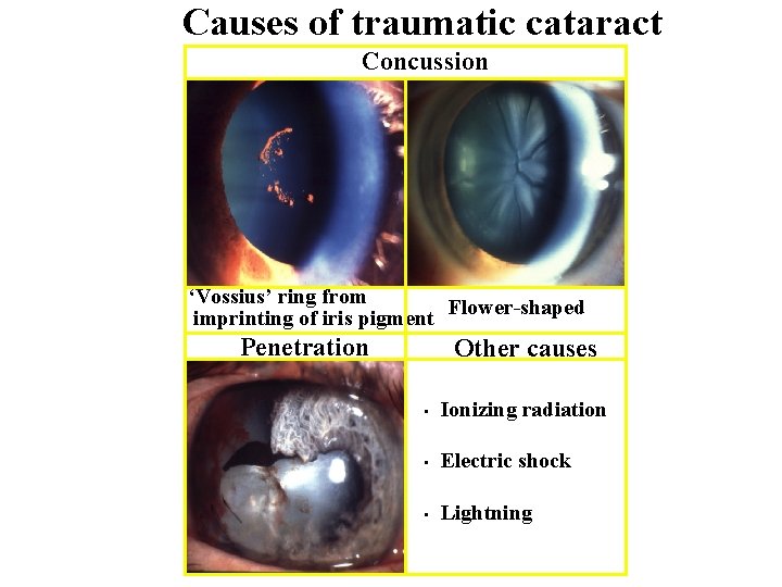 Causes of traumatic cataract Concussion ‘Vossius’ ring from imprinting of iris pigment Flower-shaped Penetration
