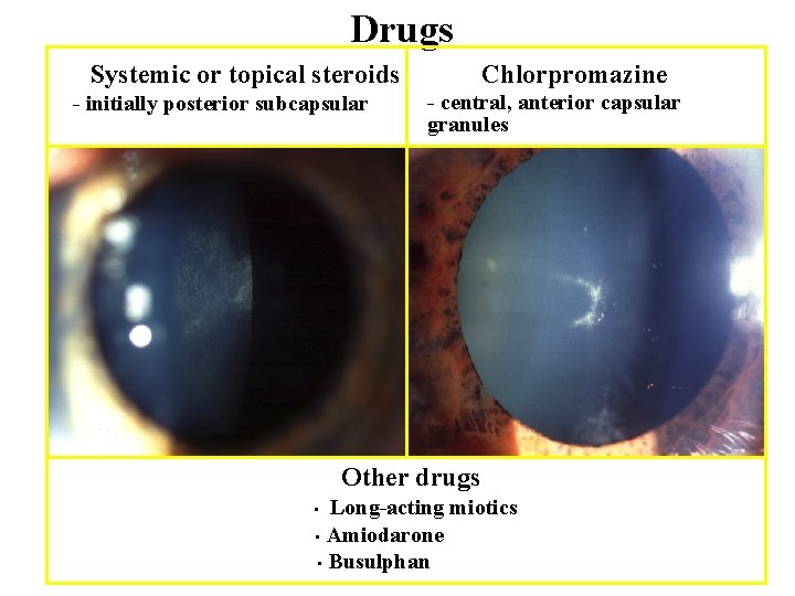 Drugs Systemic or topical steroids - initially posterior subcapsular Chlorpromazine - central, anterior capsular
