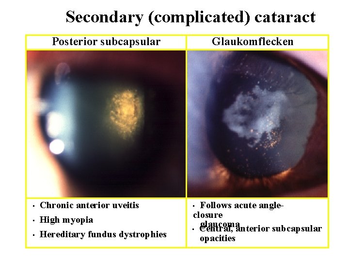 Secondary (complicated) cataract Posterior subcapsular • Chronic anterior uveitis High myopia • Hereditary fundus