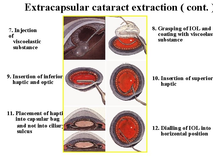 Extracapsular cataract extraction ( cont. ) 7. Injection of viscoelastic substance 8. Grasping of