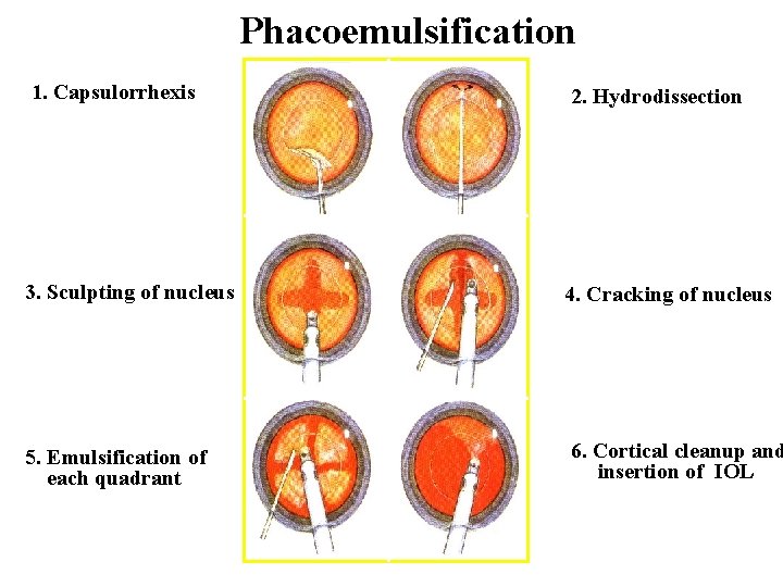 Phacoemulsification 1. Capsulorrhexis 2. Hydrodissection 3. Sculpting of nucleus 4. Cracking of nucleus 5.