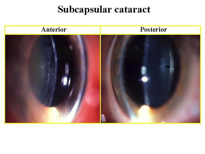 Subcapsular cataract Anterior Posterior 