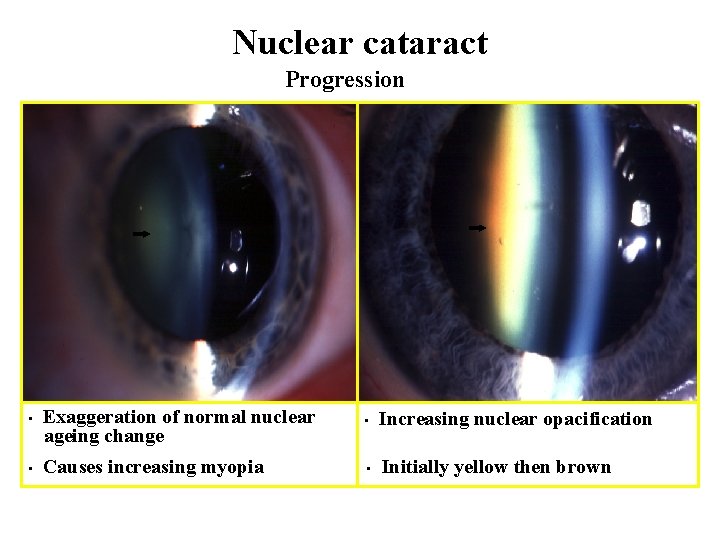 Nuclear cataract Progression • • Exaggeration of normal nuclear ageing change • Increasing nuclear