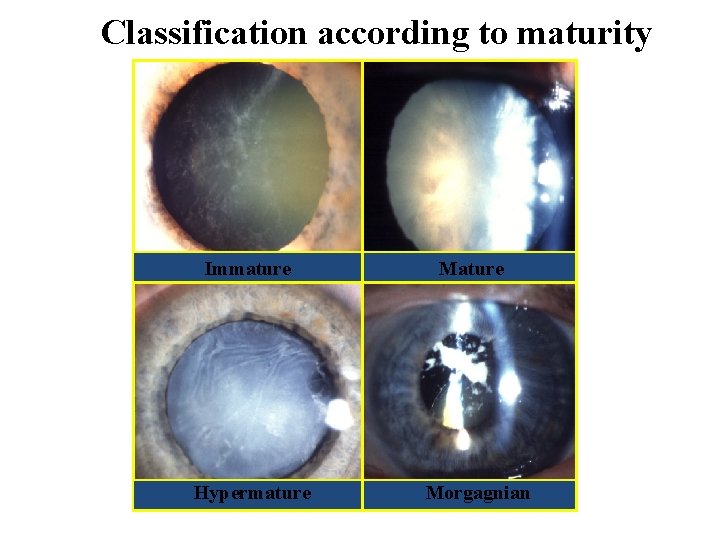 Classification according to maturity Immature Hypermature Morgagnian 