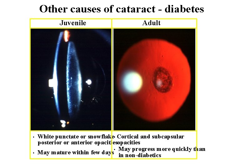 Other causes of cataract - diabetes Juvenile • • Adult White punctate or snowflake
