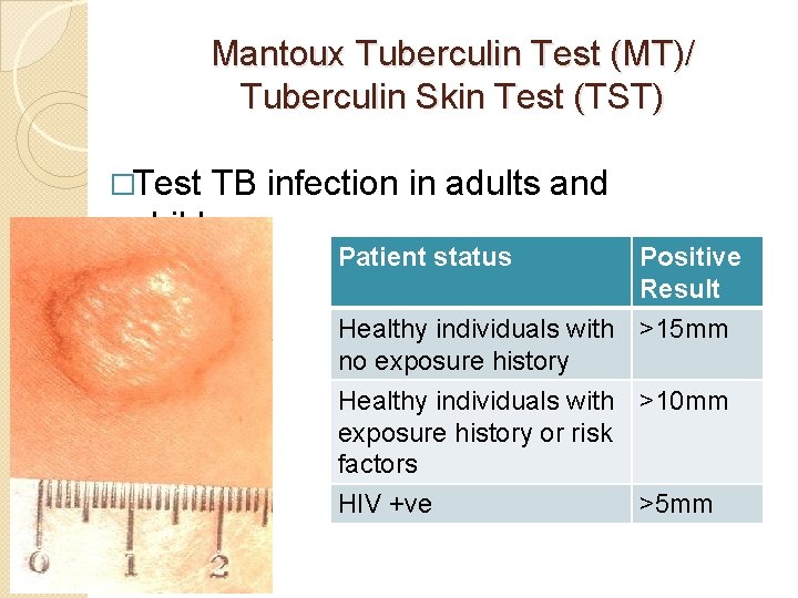 Mantoux Tuberculin Test (MT)/ Tuberculin Skin Test (TST) �Test TB infection in adults and