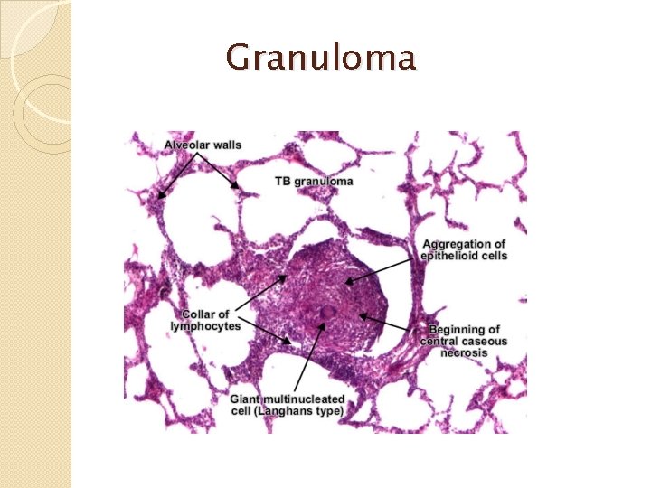 Granuloma 