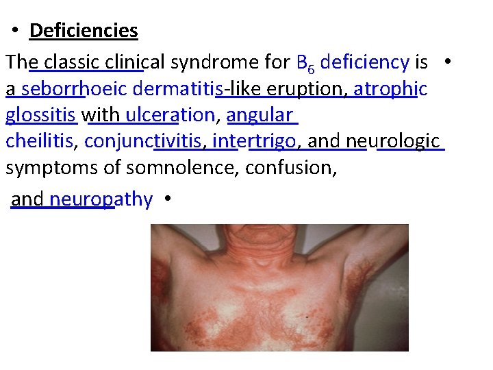  • Deficiencies The classic clinical syndrome for B 6 deficiency is • a