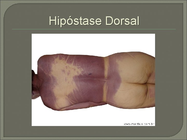 Hipóstase Dorsal 
