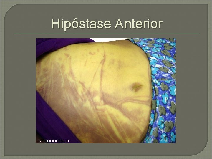 Hipóstase Anterior 