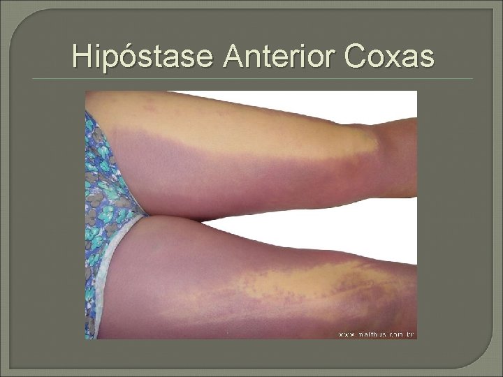 Hipóstase Anterior Coxas 