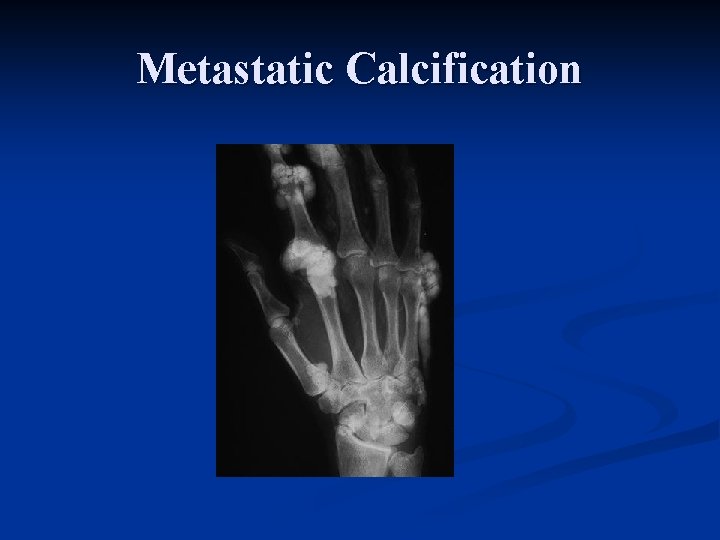 Metastatic Calcification 