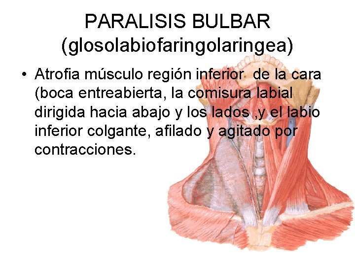 PARALISIS BULBAR (glosolabiofaringolaringea) • Atrofia músculo región inferior de la cara (boca entreabierta, la
