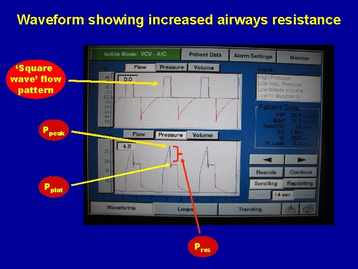 Waveform showing increased airways resistance ‘Square wave’ flow pattern Ppeak Pplat Pres 