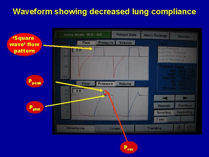 Waveform showing decreased lung compliance ‘Square wave’ flow pattern Ppeak Pplat Pres 