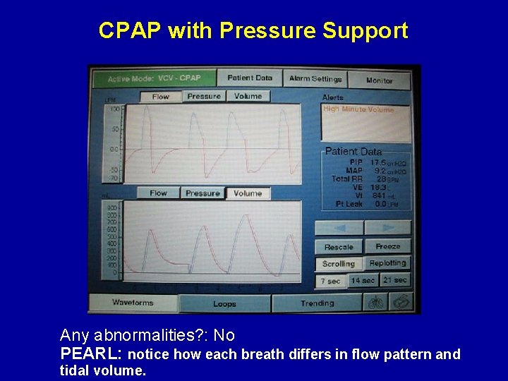 CPAP with Pressure Support Any abnormalities? : No PEARL: notice how each breath differs