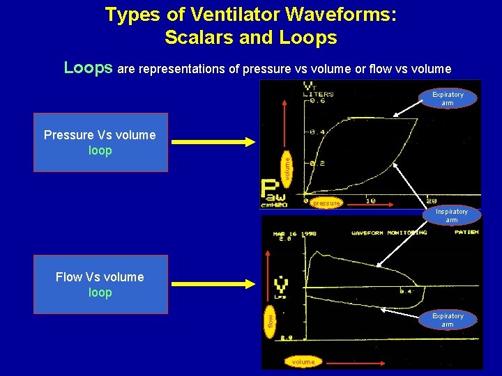 Types of Ventilator Waveforms: Scalars and Loops are representations of pressure vs volume or