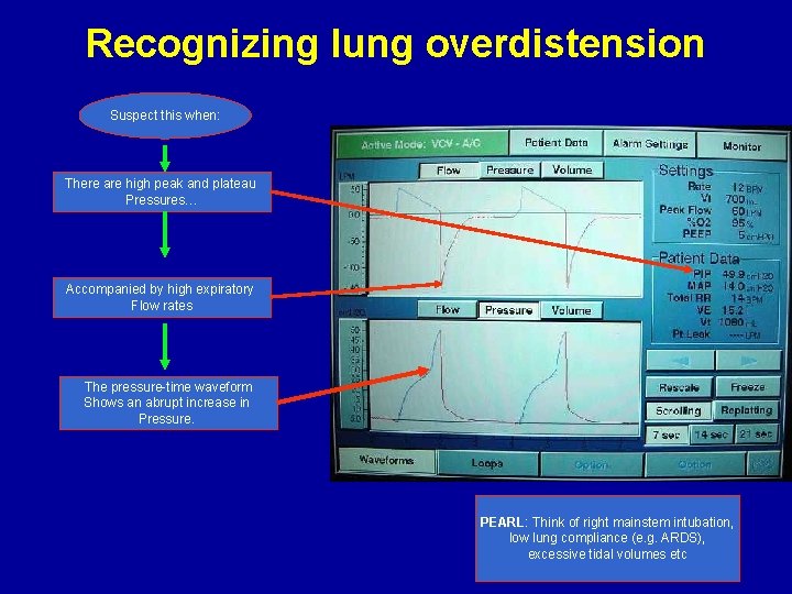 Recognizing lung overdistension Suspect this when: There are high peak and plateau Pressures… Accompanied